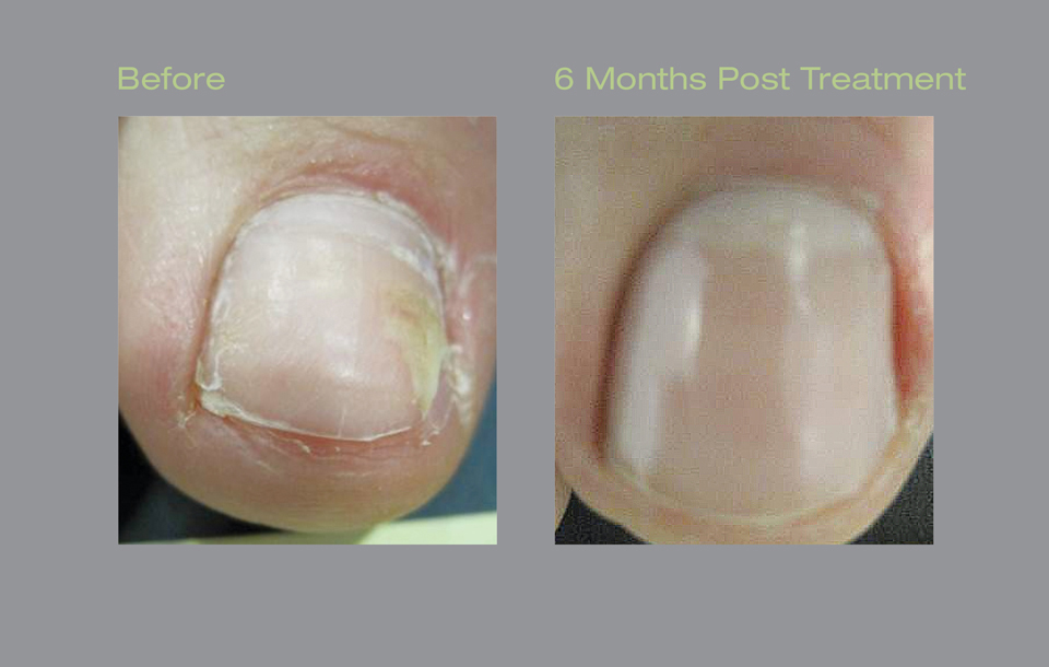 CUTERA-BEFORE-AND-AFTER-FUNGAL-TREATMENT